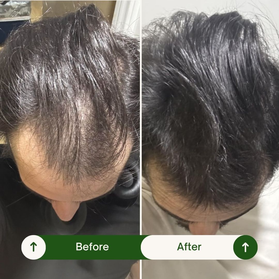 Two overhead scalp photographs labelled Before and After.
